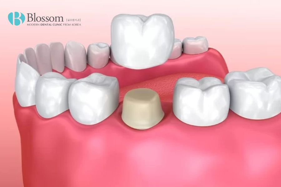 Trồng răng sứ hiệu quả với phương pháp sử dụng mão sứ từ vật liệu cao cấp