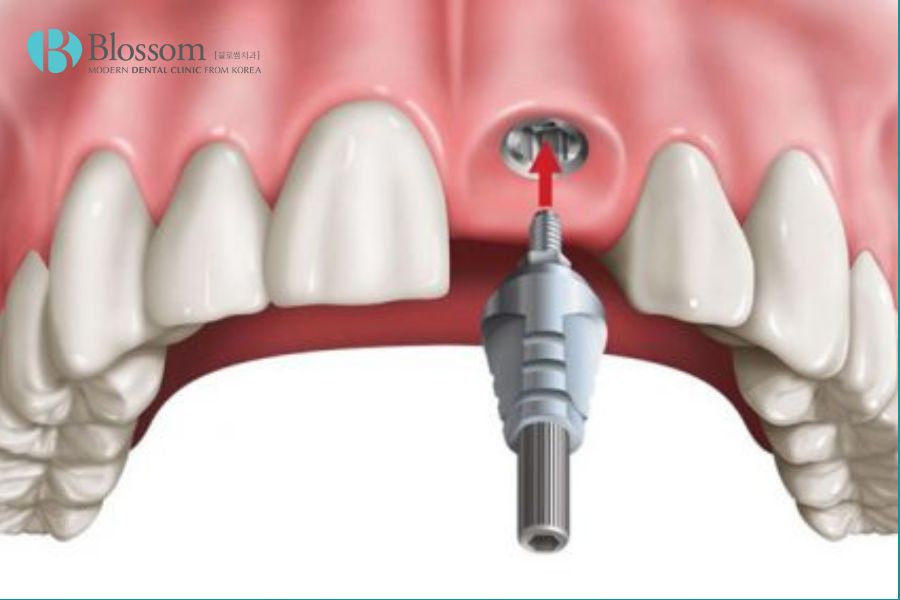Trồng răng thỏ bằng implant là phương pháp thẩm mỹ nha khoa hiện đại.