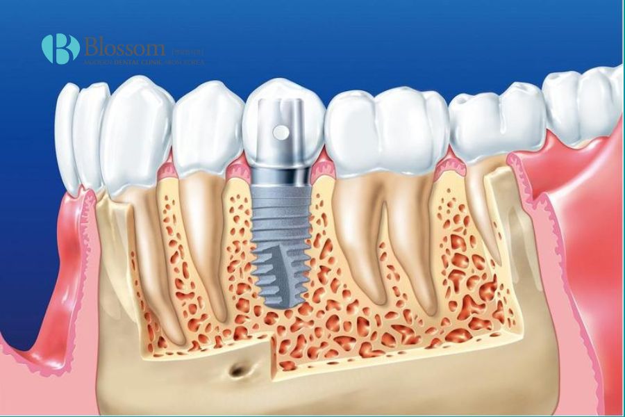 Trồng răng vĩnh viễn là kỹ thuật thẩm mỹ phục hồi những chiếc răng bị gãy, sứt mẻ