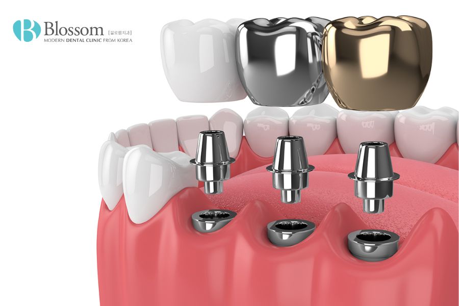 Trụ Implant là loại vật liệu nha khoa phổ biến, thường được làm từ chất liệu Titanium