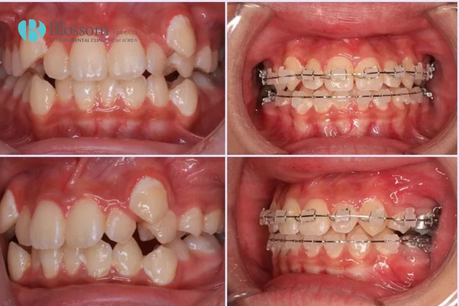 Trước và sau khi niềng răng mắc cài kim loại cho thấy khuôn hàm có sự thay đổi rõ rệt.