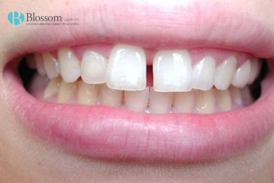 Trường hợp răng thưa hoặc hở kẽ nên thực hiện dán sứ Veneer Emax