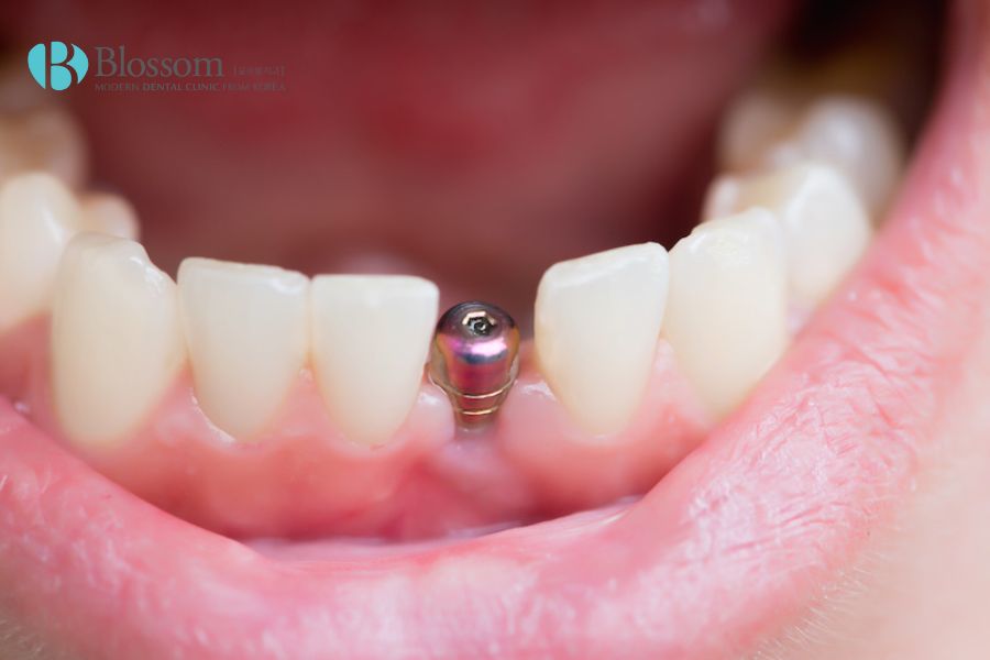 Tuổi thọ răng được kéo dài với phương pháp cấy ghép Implant nếu được chăm sóc tốt