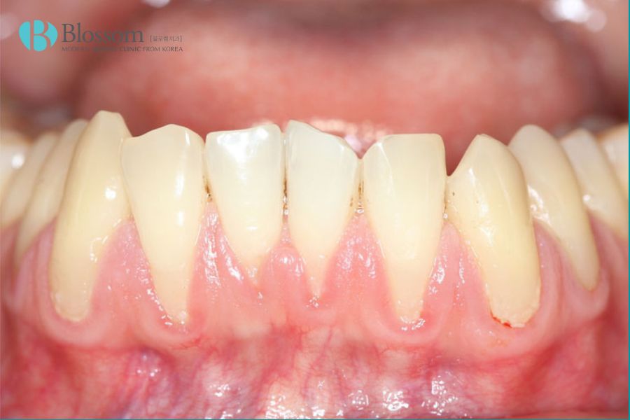 Tụt nướu là hiện tượng nướu bị tụt xa khỏi răng, làm lộ ra chân răng.