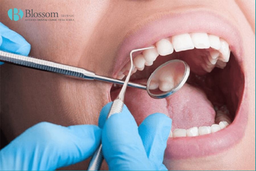 Tùy theo tình trạng mà bạn sẽ có cảm nhận đau ê buốt khác nhau khi thực hiện cạo vôi răng.