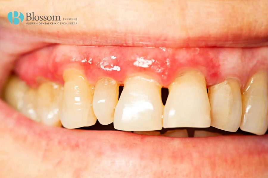 Việc chưa điều trị triệt để các bệnh về răng miệng sẽ gây ra tình trạng đau sau khi thực hiện dán sứ