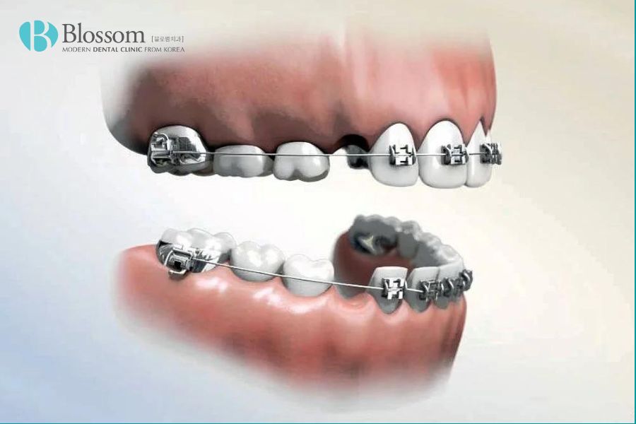 Việc có cần nhổ răng khi chỉnh nha hay không và nhổ những răng nào phụ thuộc vào nhiều yếu tố.