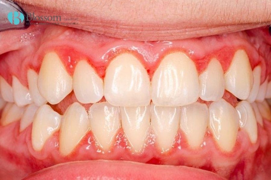 Việc đắp răng sứ gây chảy máu là do sai kỹ thuật khi mài răng, làm tổn thương mô nướu
