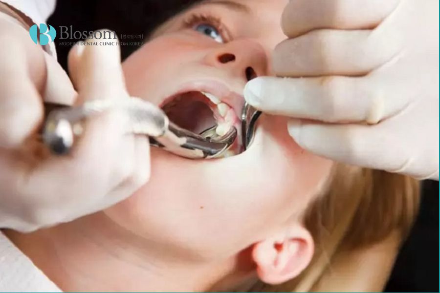 Việc quyết định nhổ bỏ răng nanh cần được đưa ra bởi nha sĩ có chuyên môn.