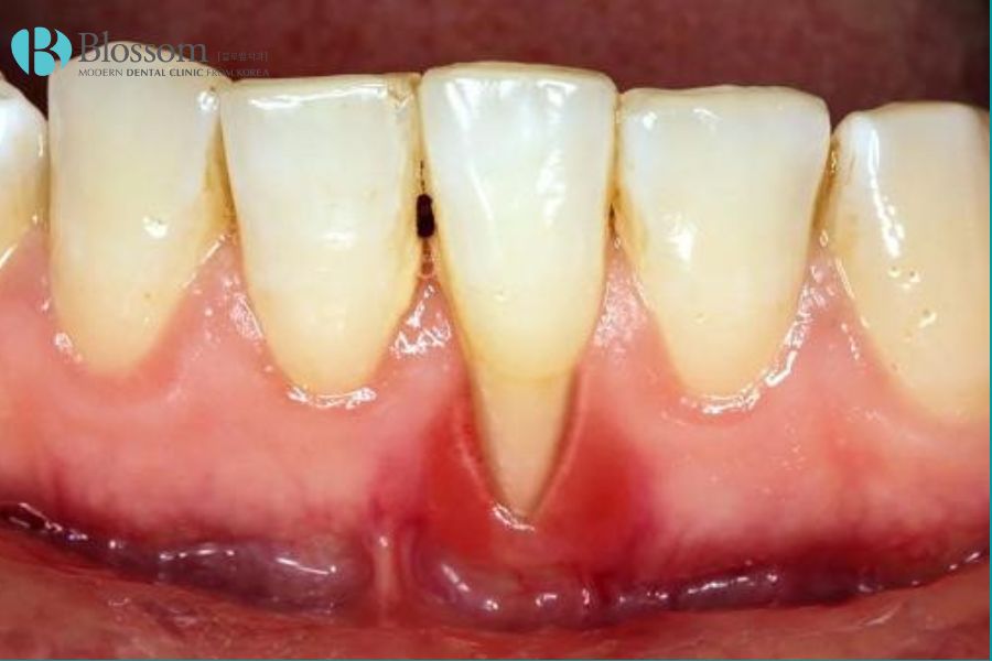 Viêm nha chu là bệnh nhiễm trùng nướu răng nghiêm trọng, ảnh hưởng đến các mô xung quanh răng.