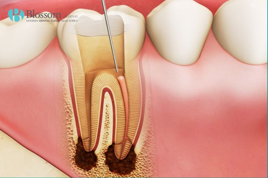 Viêm tủy hoại tử là giai đoạn nặng nhất của bệnh viêm tủy răng.