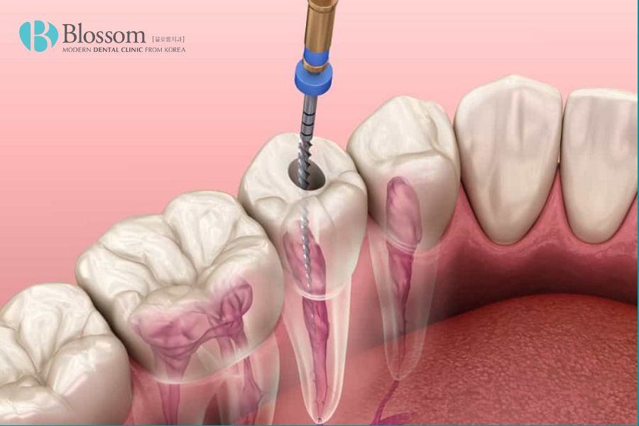 Viêm tủy không phục hồi là giai đoạn tiến triển nặng hơn của bệnh viêm tủy răng.