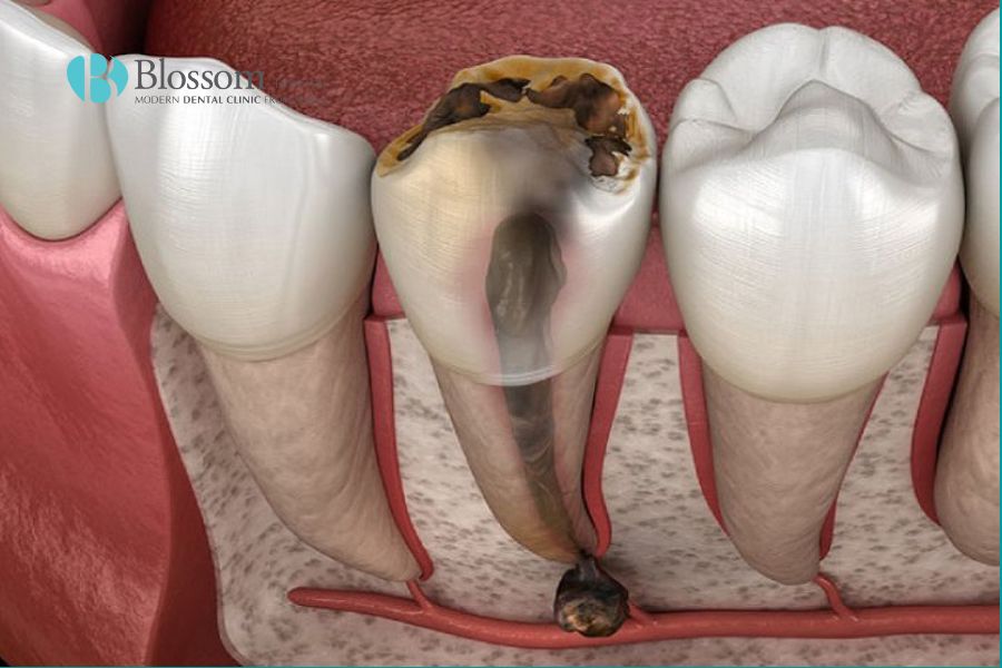 Viêm tủy răng là tình trạng viêm nhiễm xảy ra ở tủy răng, phần mô mềm nằm sâu bên trong răng.