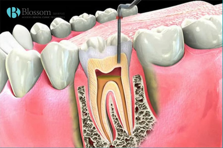 Viêm tủy răng phục hồi là giai đoạn đầu tiên của bệnh viêm tủy răng.