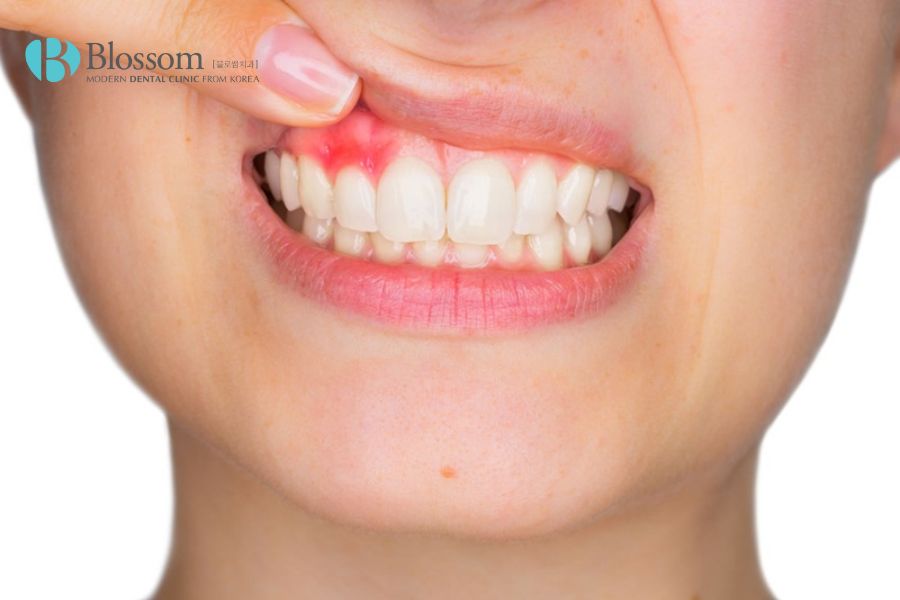 Xuất hiện vấn đề nướu sưng là dấu hiệu bất thường sau quá trình bọc răng sứ
