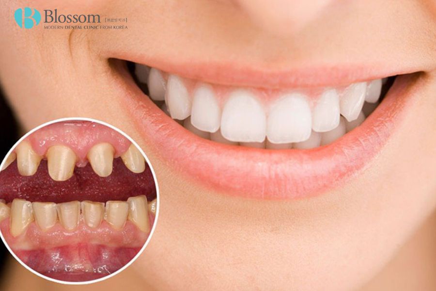 Bọc răng sứ giúp cải thiện triệt để tình trạng răng nhỏ.