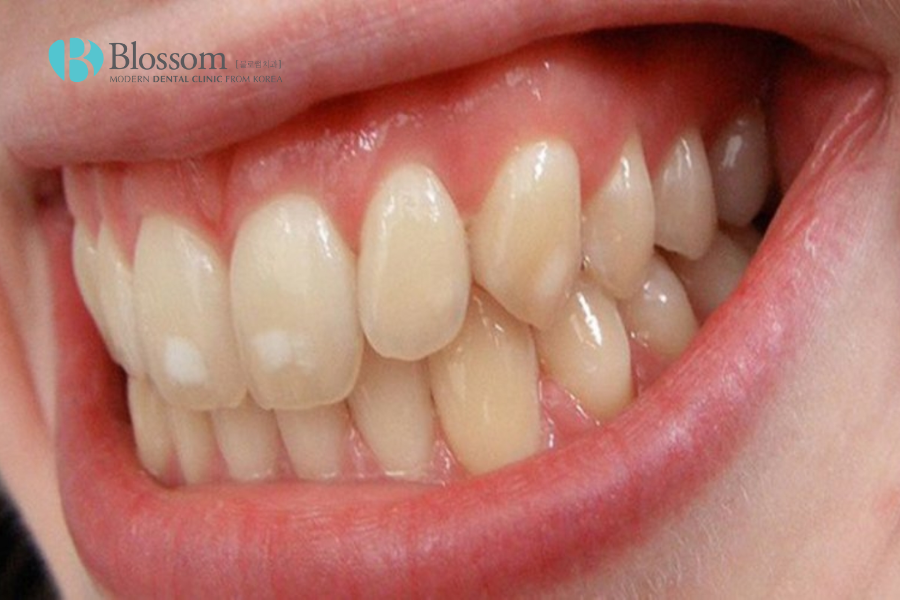Các dấu hiệu của răng nhiễm kháng sinh rất điển hình.