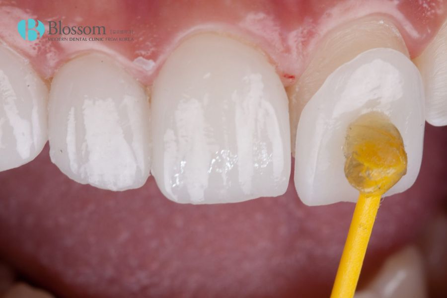 Dán răng sứ là một trong những biện pháp cải thiện tình trạng răng nhỏ hiệu quả.