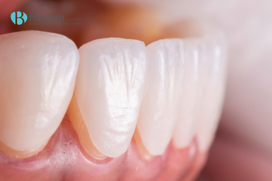 Kỹ thuật dán răng sứ áp dụng trong nhiều trường hợp răng nhiễm kháng sinh nặng.