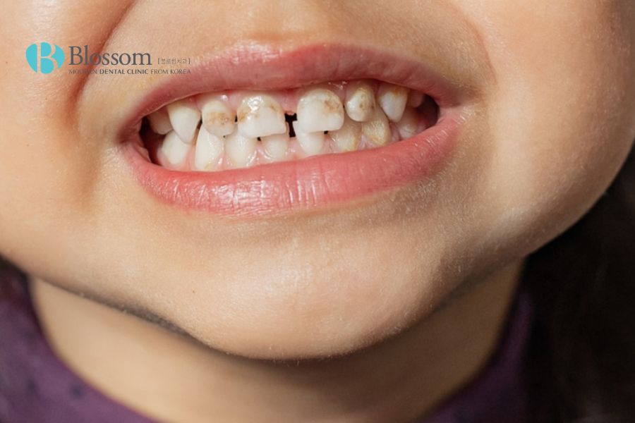 Lạm dụng kháng sinh Tetracycline ở trẻ sẽ khiến các bé phải đối mặt với nguy cơ có một hàm răng vĩnh viễn bị sậm màu.
