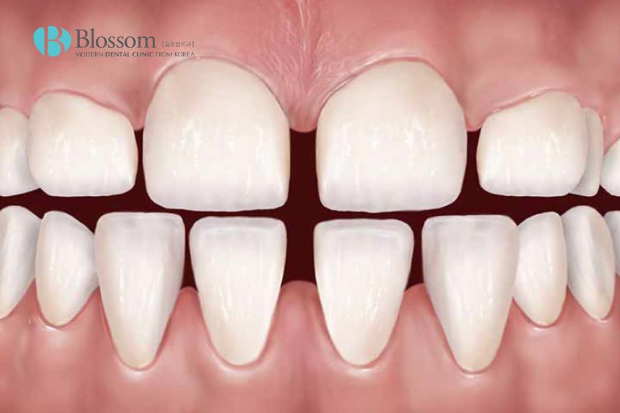 Người có hàm răng nhỏ và thưa được cho là thường kém may mắn trong cuộc sống.