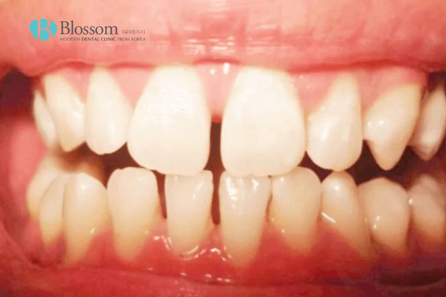 Nguyên nhân gây ra tình trạng răng nhỏ có thể xuất phát từ nhiều lý do.