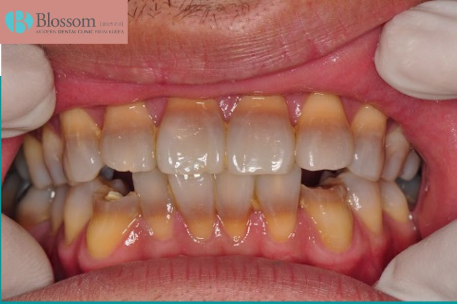Răng bị nhiễm kháng sinh là tình trạng nha khoa thường gặp.