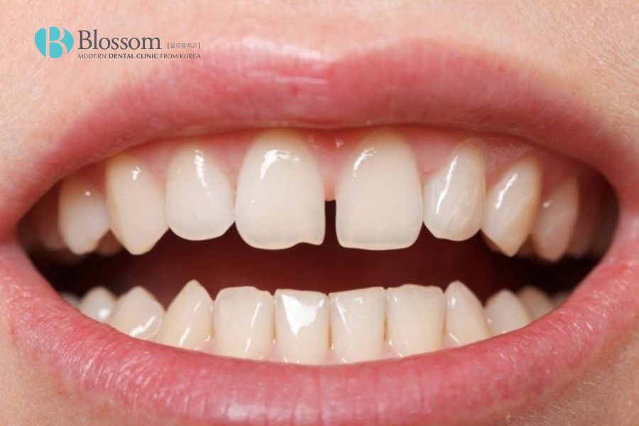 Răng nhỏ dưới góc nhìn nhân tướng học phần lớn là dáng răng không tốt.