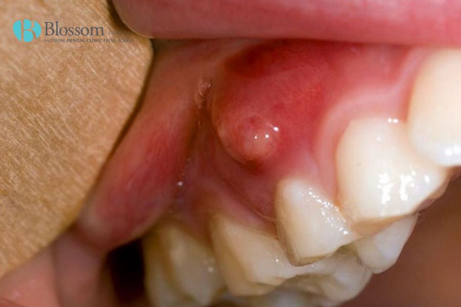 Nguyên nhân - dấu hiệu và cách điều trị áp xe răng 2 ap xe rang 1