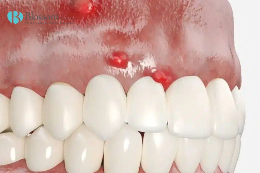 Nguyên nhân - dấu hiệu và cách điều trị áp xe răng 5 ap xe rang 4