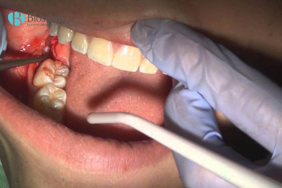 Nguyên nhân - dấu hiệu và cách điều trị áp xe răng 6 ap xe rang 5