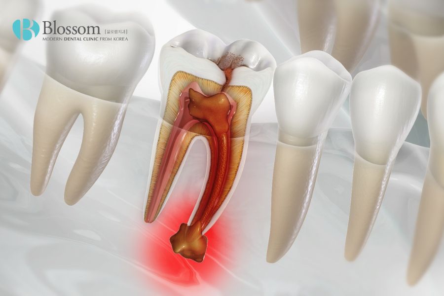 Nguyên nhân - dấu hiệu và cách điều trị áp xe răng 7 ap xe rang 6