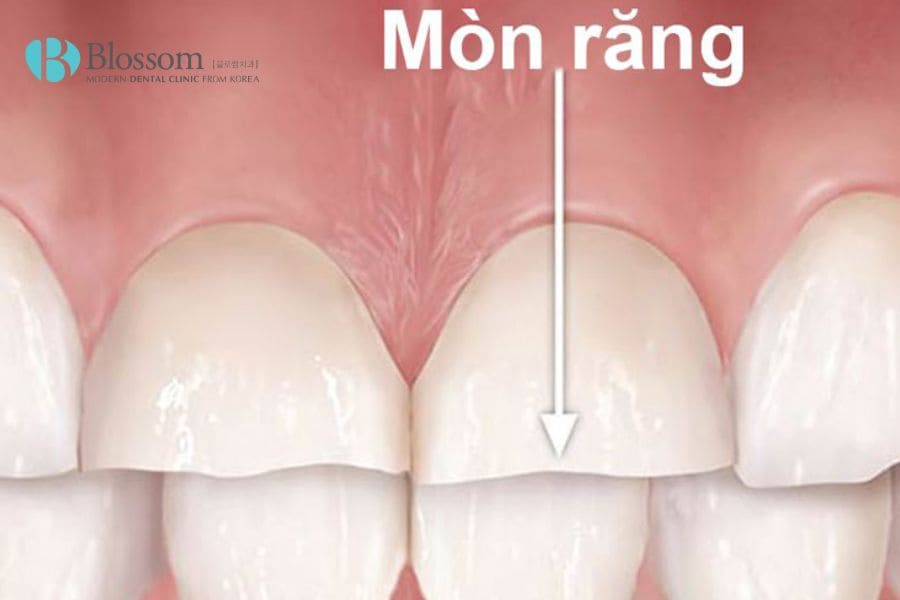 cac benh ve rang mieng 5