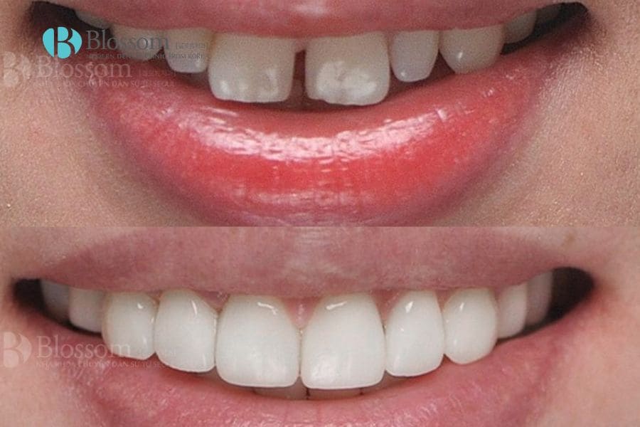 Giới thiệu 10+ cách làm trắng răng bị ố vàng đơn giản, hiệu quả 12 cach lam rang trang bi o vang 0