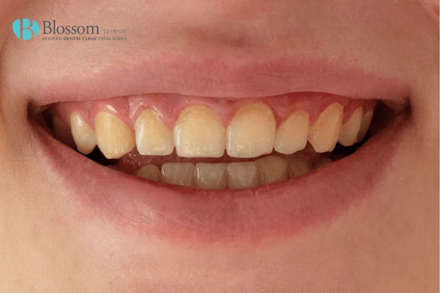 Giới thiệu 10+ cách làm trắng răng bị ố vàng đơn giản, hiệu quả 2 cach lam trang rang bi o vang 1