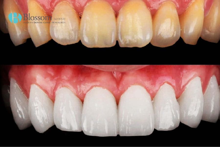Giới thiệu 10+ cách làm trắng răng bị ố vàng đơn giản, hiệu quả 11 cach lam trang rang bi o vang 10