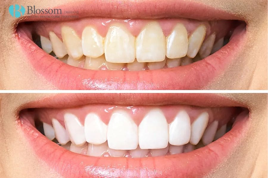 Giới thiệu 10+ cách làm trắng răng bị ố vàng đơn giản, hiệu quả 3 cach lam trang rang bi o vang 2