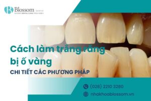Giới thiệu 10+ cách làm trắng răng bị ố vàng đơn giản, hiệu quả