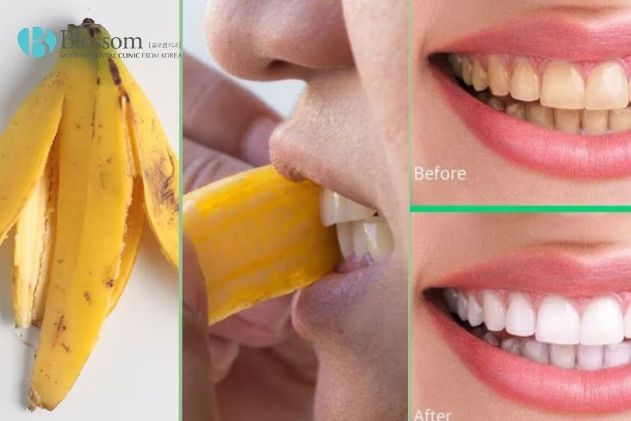 Giới thiệu 10+ cách làm trắng răng bị ố vàng đơn giản, hiệu quả 7 cach lam trang rang bi o vang 6