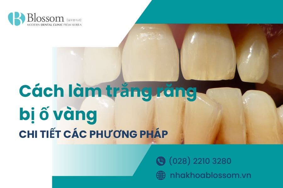 Giới thiệu 10+ cách làm trắng răng bị ố vàng đơn giản, hiệu quả