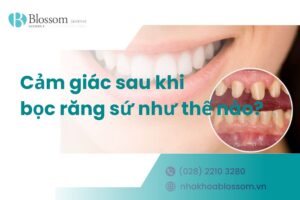 [Giải đáp] Cảm giác sau khi bọc răng sứ như thế nào?