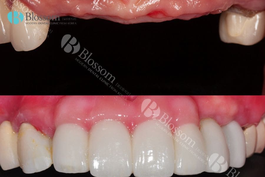 Cấy ghép Implant là gì? Những thông tin cần biết 12 cay ghep implant 11