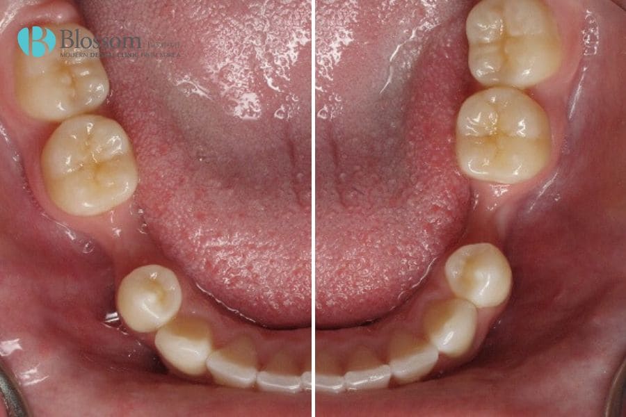 Cấy ghép Implant là gì? Những thông tin cần biết 13 cay ghep implant 12