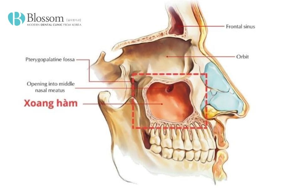 Cấy ghép Implant là gì? Những thông tin cần biết 5 cay ghep implant 4