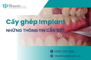 Cấy ghép Implant là gì? Những thông tin cần biết