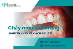 Chảy máu chân răng do đâu? Cách điều trị như thế nào?