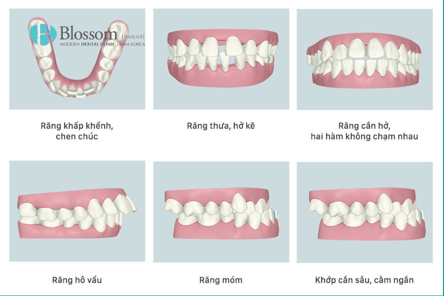 Chỉnh nha là gì? Một số phương pháp chỉnh nha phổ biến 3 chinh nha la gi 2