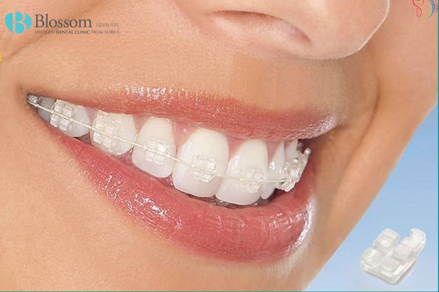 Chỉnh nha là gì? Một số phương pháp chỉnh nha phổ biến 5 chinh nha la gi 4