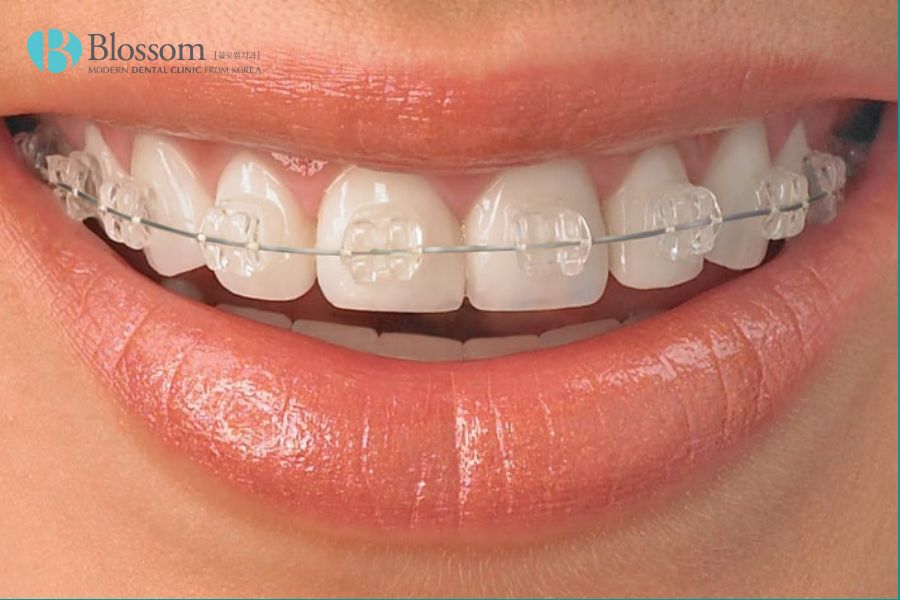 Chỉnh nha là gì? Một số phương pháp chỉnh nha phổ biến 6 chinh nha la gi 5