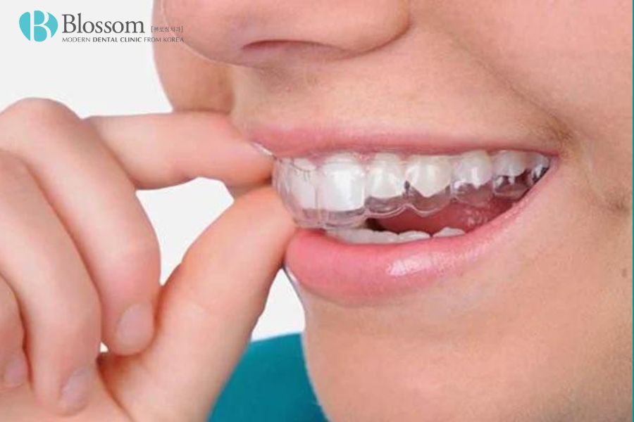 Chỉnh nha là gì? Một số phương pháp chỉnh nha phổ biến 7 chinh nha la gi 6